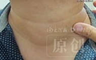 30岁男子患癌后拒绝手术想凭意念消除癌细胞，医生回应