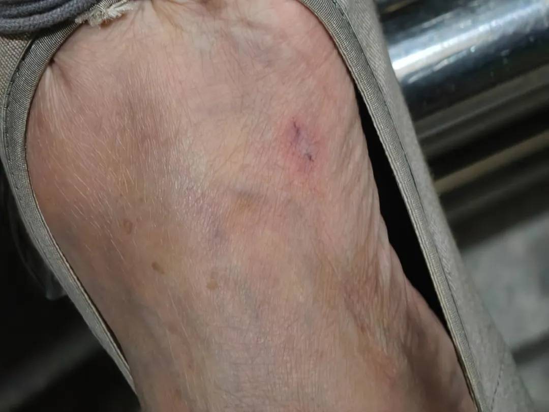 上海七旬老人小区散步被毒蛇咬伤,女儿崩溃:医院怎么选……这份救命指南快收好!