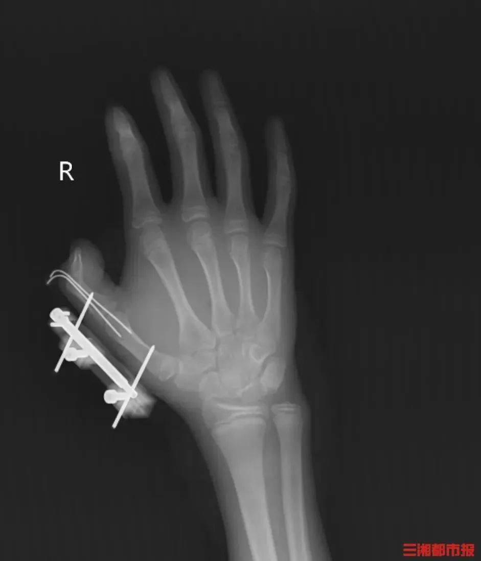 突然爆炸!这个常见保鲜品暗藏危险!